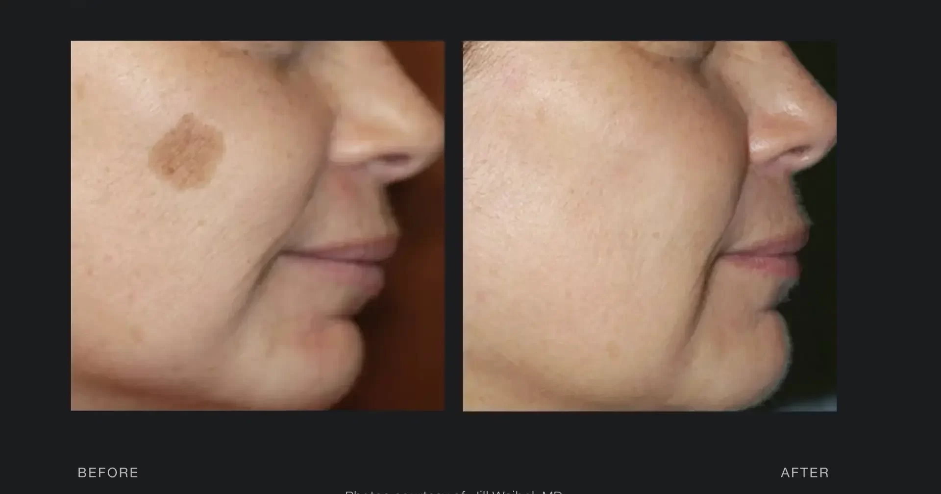 Skin pigmentation treatment | before and after | Advanced Care & Medspa | Lisle, IL